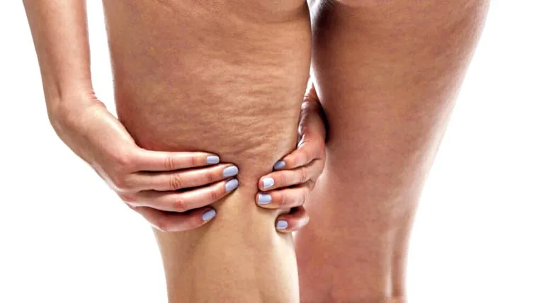 Punya Stretch Mark Di Tubuh