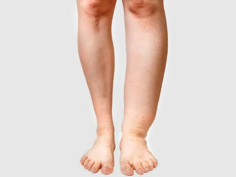 Mengenal Filariasis, Penyakit Kaki Gajah yang Disebabkan