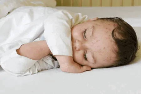 cacar air bayi