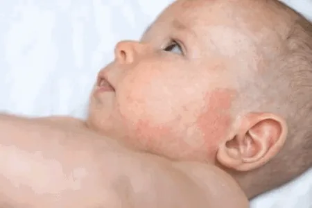 alergi pada bayi