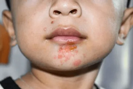 Impetigo pada kulit di sekitar mulut bayi, luka berkerak kekuningan