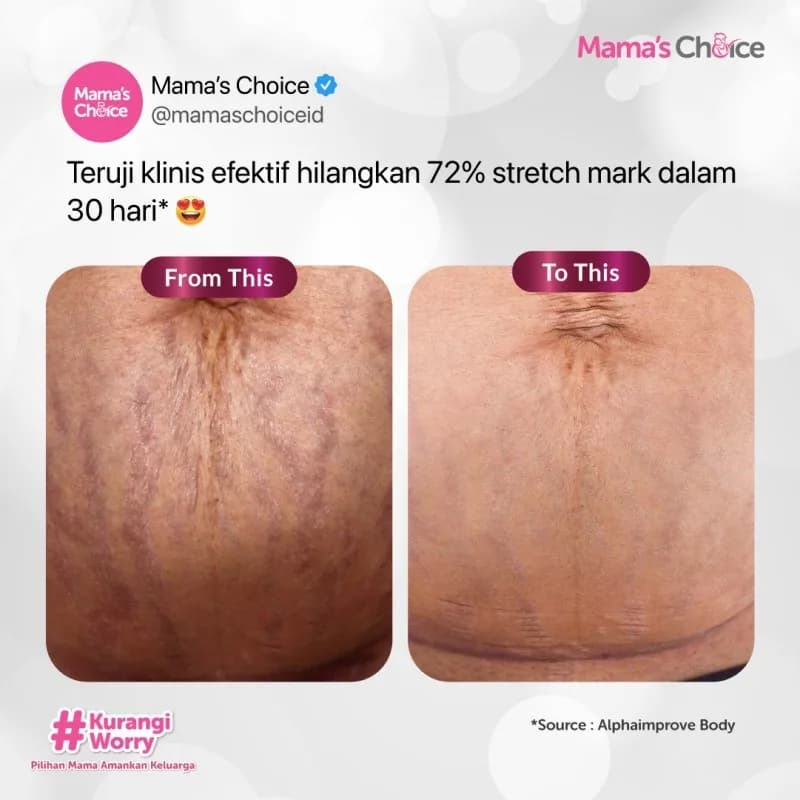 Cegah Stretch Mark sebelum Muncul di Perut Mama