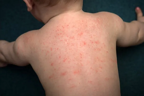 cara cepat mengatasi keringat buntet pada bayi dengan salep