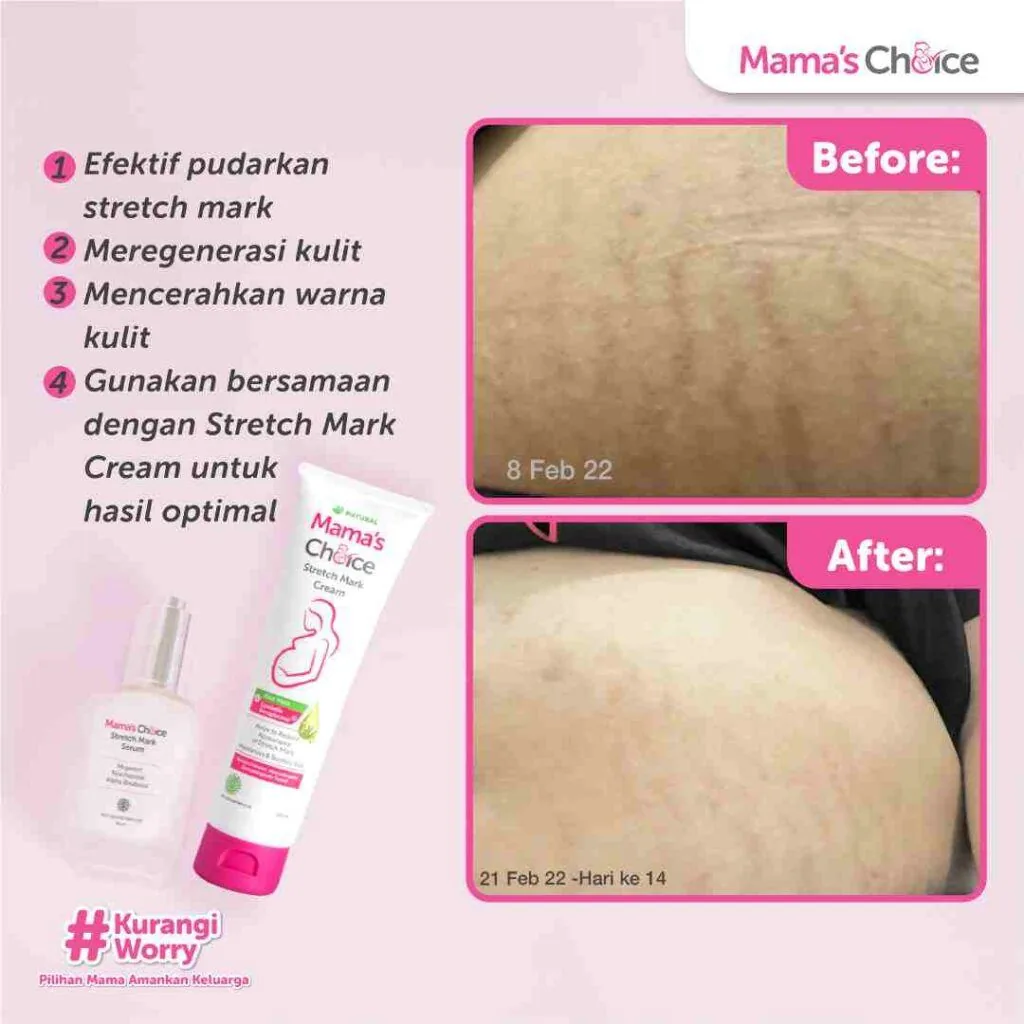 Stretch Mark Testimoni Atasi Perut Gatal Saat Alami