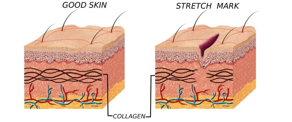 Stretch marks in pregnancy
