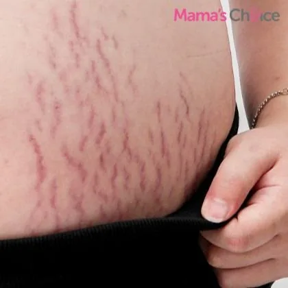 Caring for stretch marks