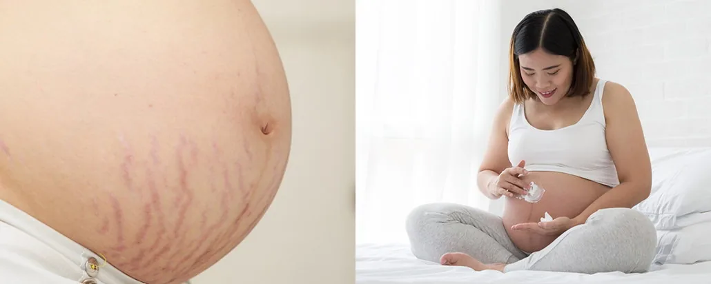 penyebab stretch mark