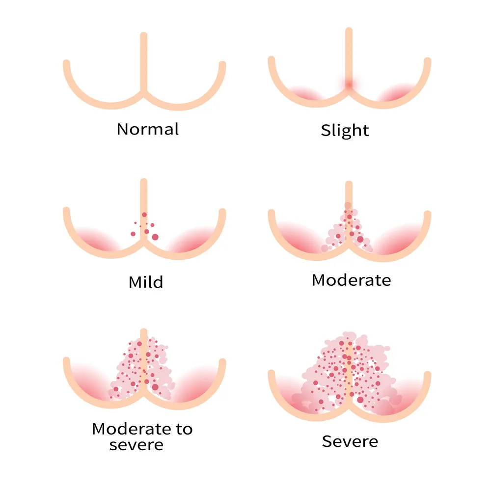 Signs of nappy rash
