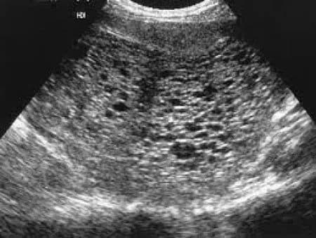 Gambar USG Kantung Janin yang Abnormal