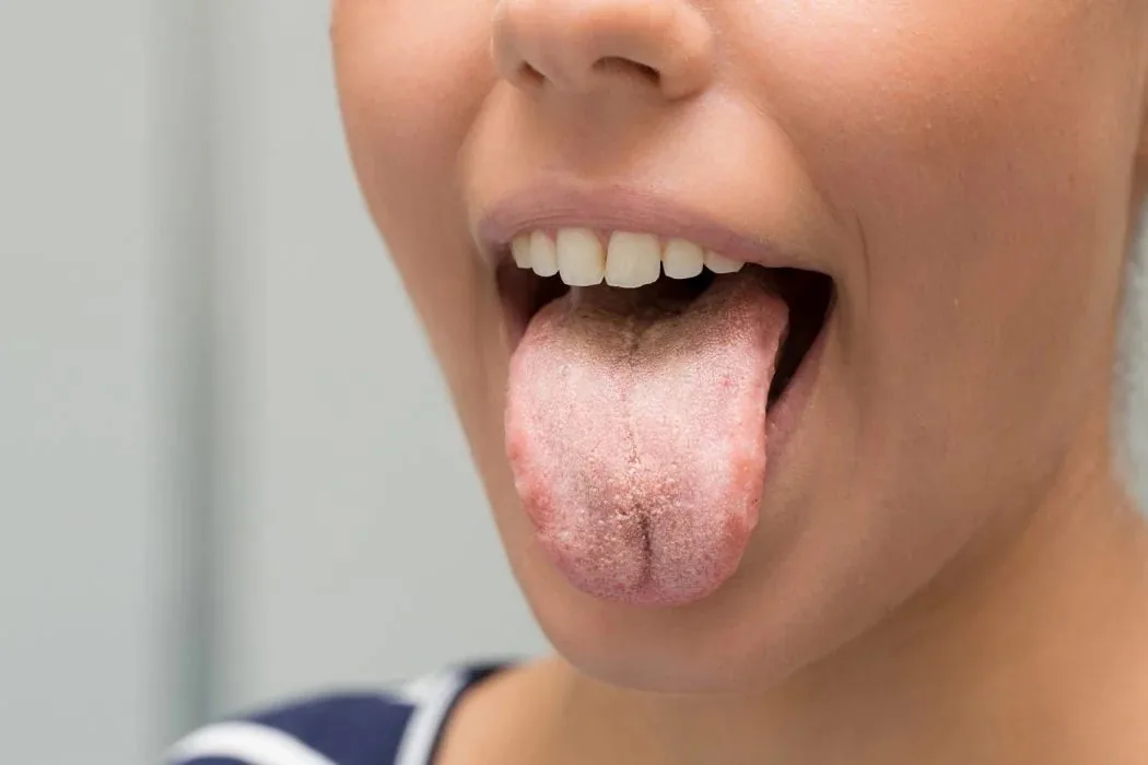 Cara nepangi tandha halitosis