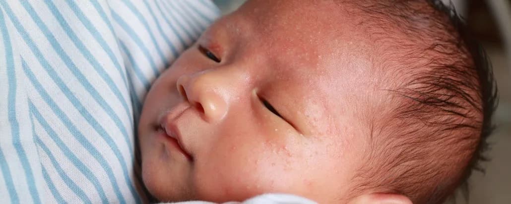 Kenali Penyebab dan Cara Mengatasi Jerawat pada Bayi