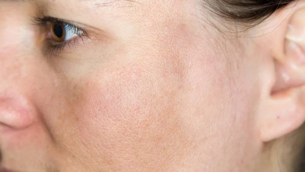 Melasma adalah masalah kulit saat hamil