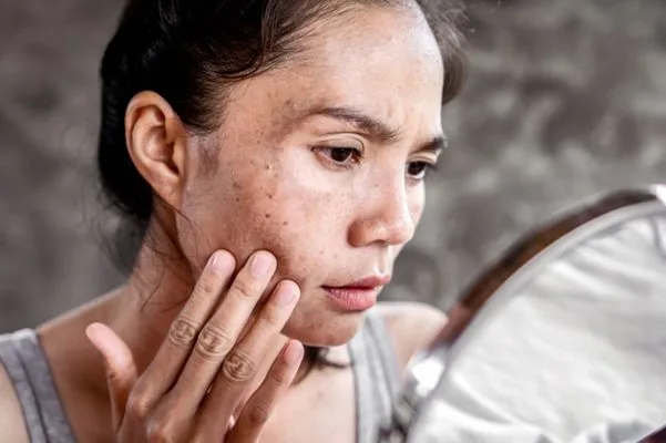 Melasma pada ibu hamil