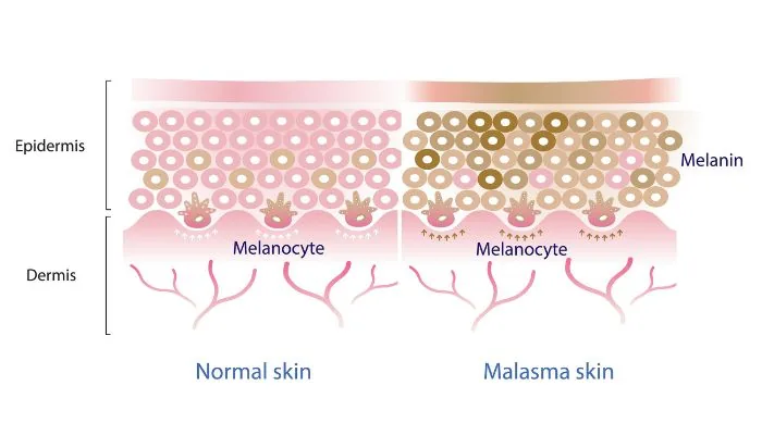 Perbedaan Kulit Normal dan Melasma