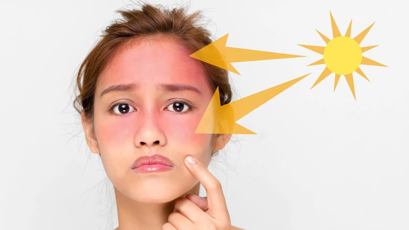 Melasma pada Kulit Wajah, Ini 4 Penyebab Utamanya