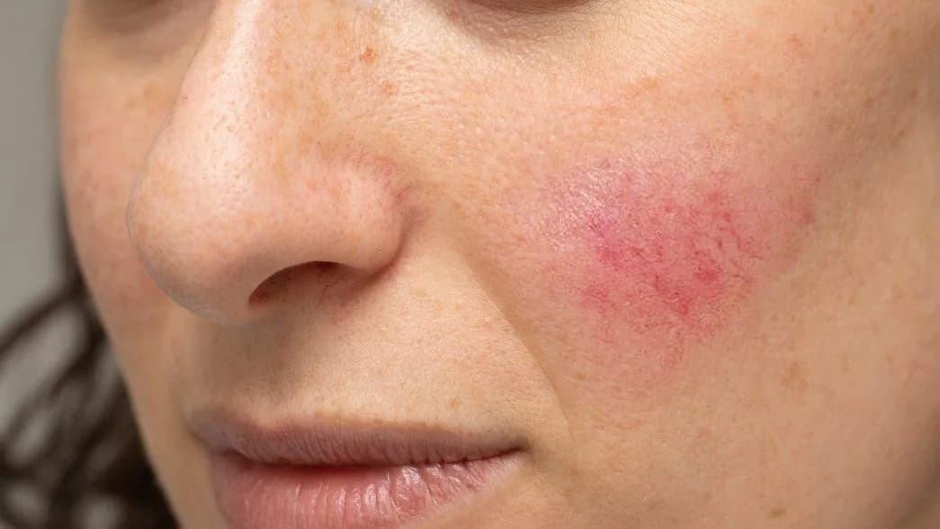 alergi kosmetik bisa menyebabkan melasma