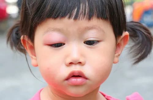 mengobati bengkak akibat gigitan serangga pada bayi