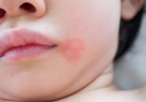Mosquito bites on a baby