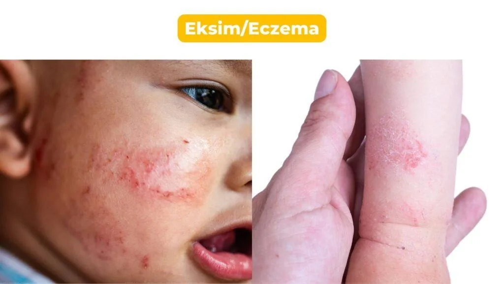 Eksim pada bayi