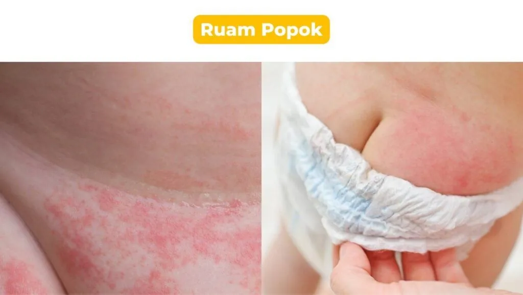 Ruam popok pada bayi