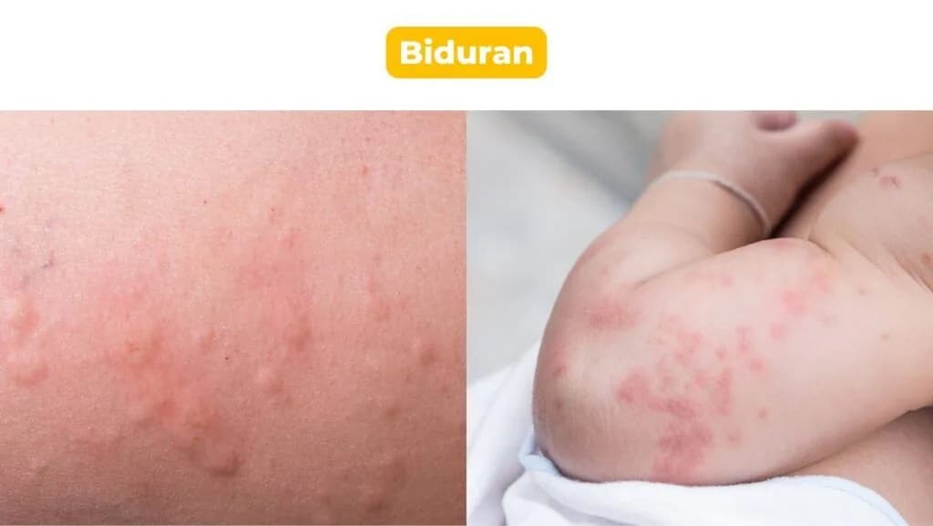 Biduran pada bayi