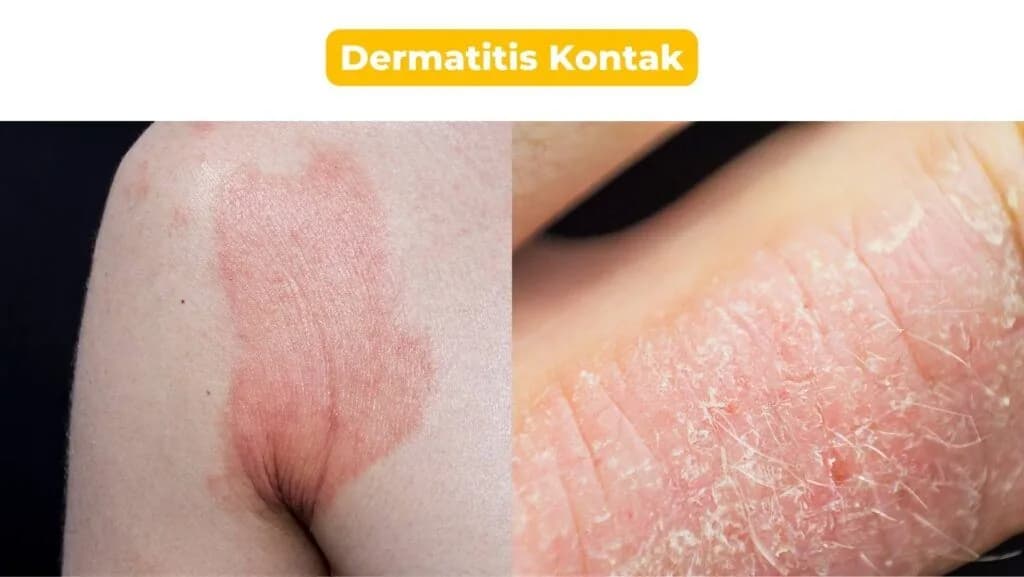 Dermatitis Kontak pada bayi