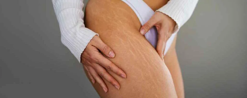 Masih Remaja Sudah Muncul Stretch Mark? Tenang