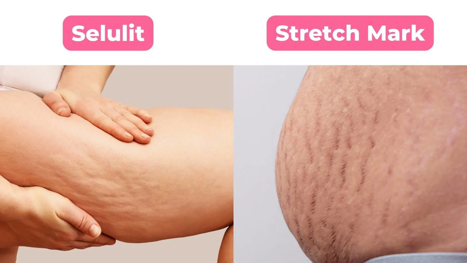 Perbedaan stretch mark dan selulit