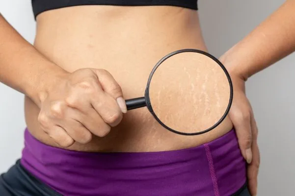What causes stretch marks