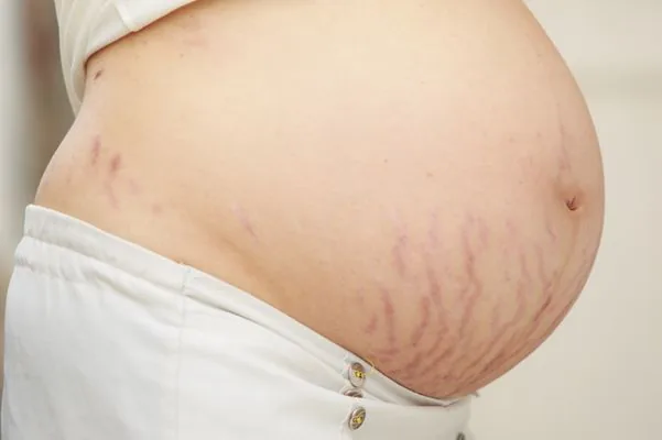 Red stretch marks