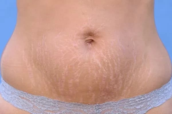 White stretch marks