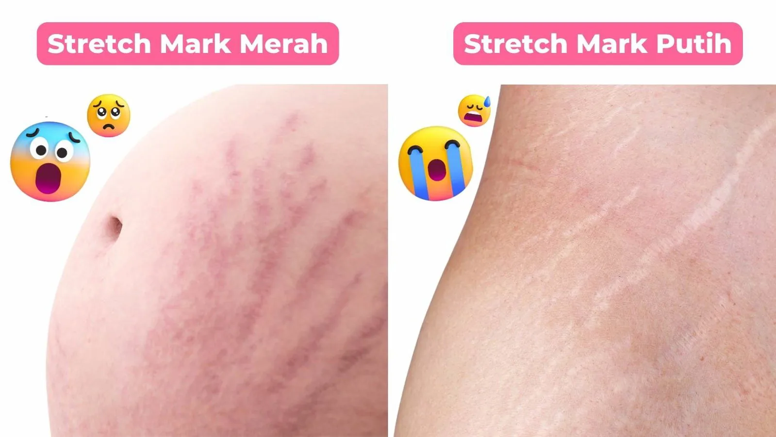 The difference between red and white stretch marks