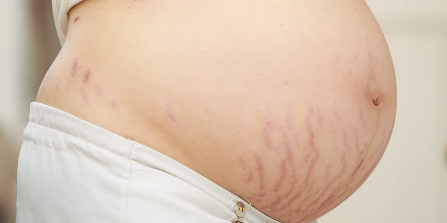 Red stretch marks in pregnancy
