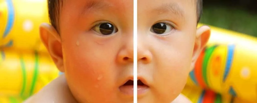 Sunburnt baby skin