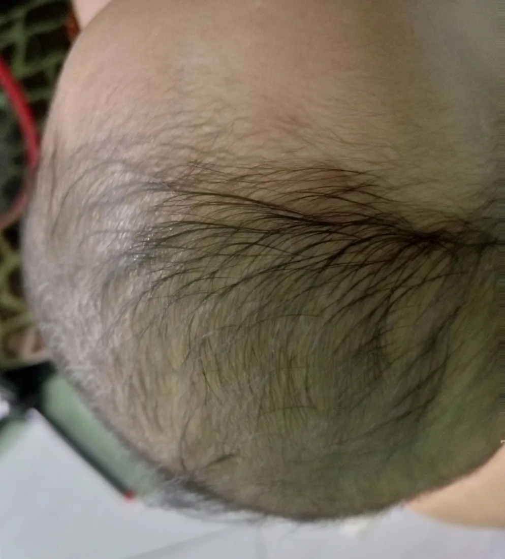 Rambut si Kecil, sebelum dan hari ke-14, Hari ke-14