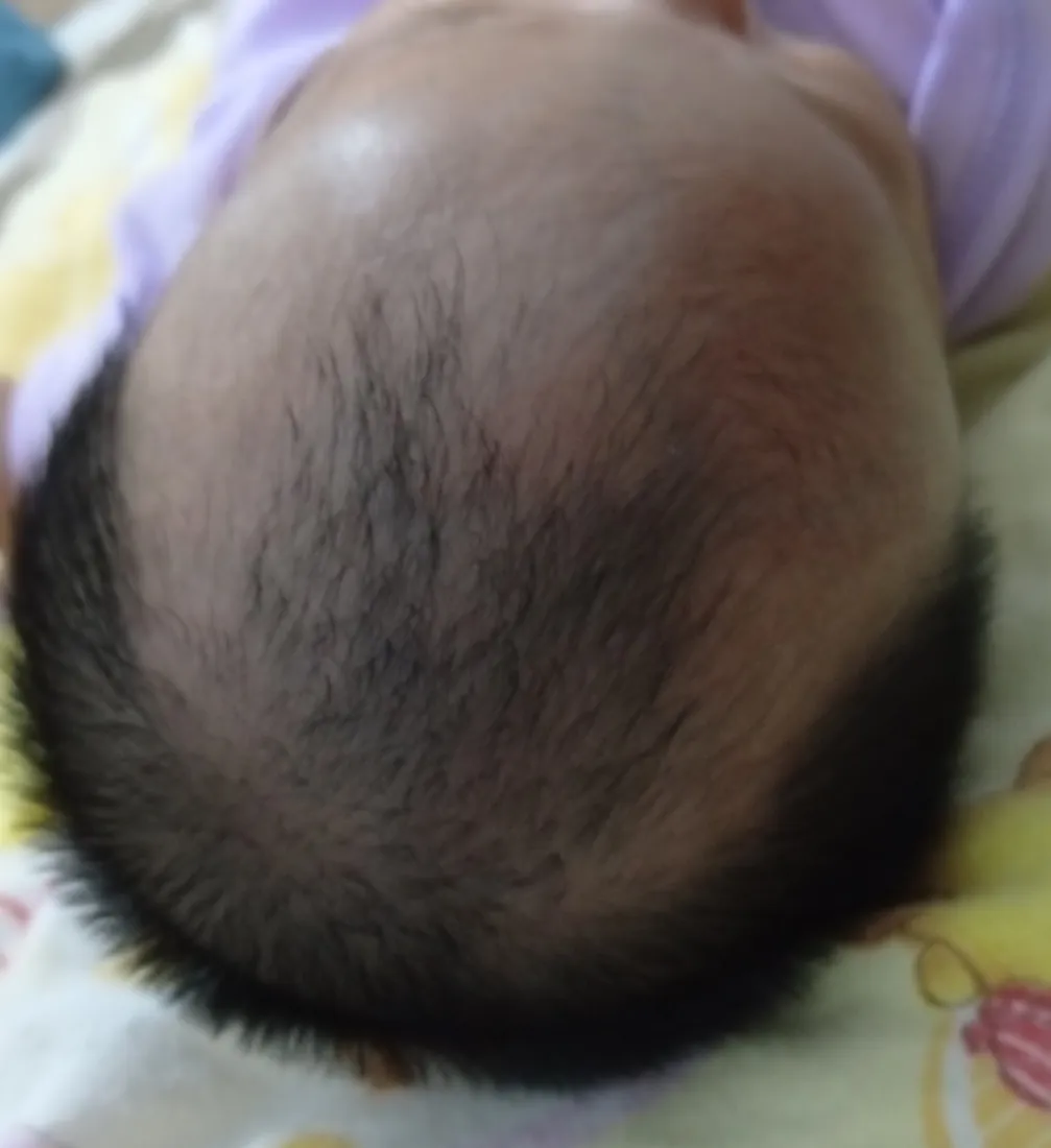 Rambut si Kecil, sebelum dan hari ke-14, Hari ke-14