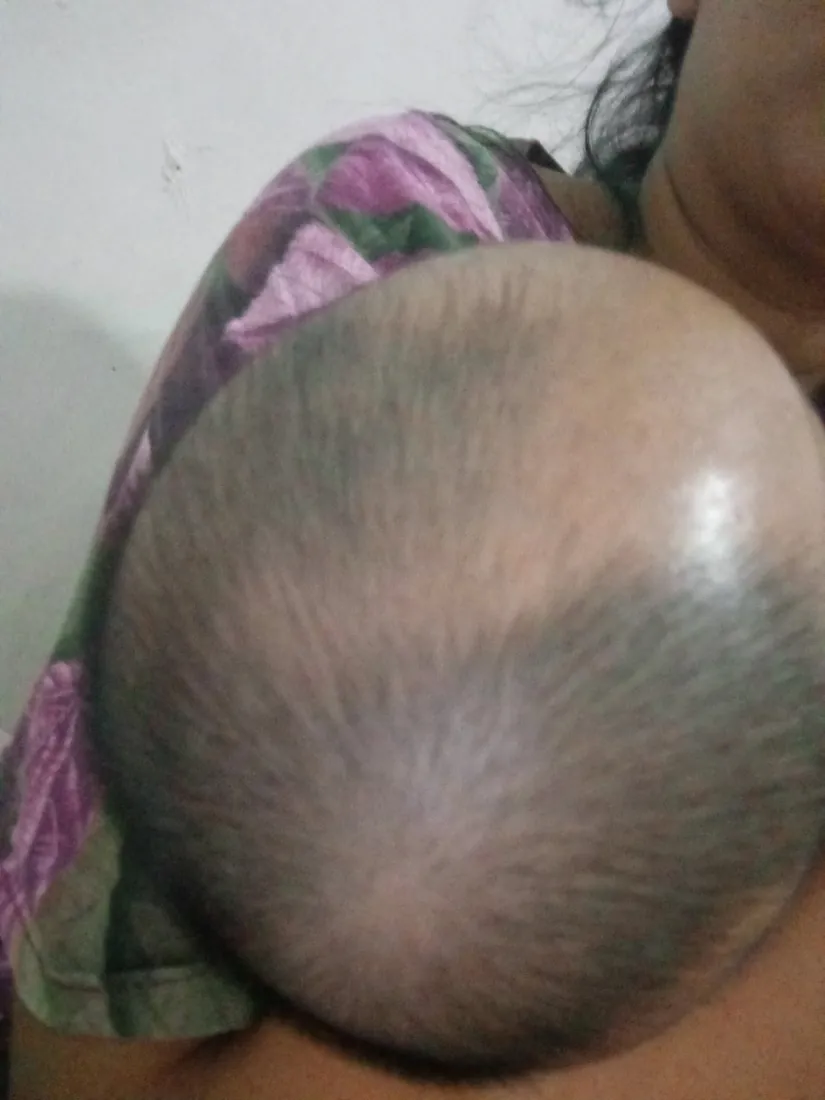 Rambut si Kecil, sebelum dan hari ke-14, Sebelum