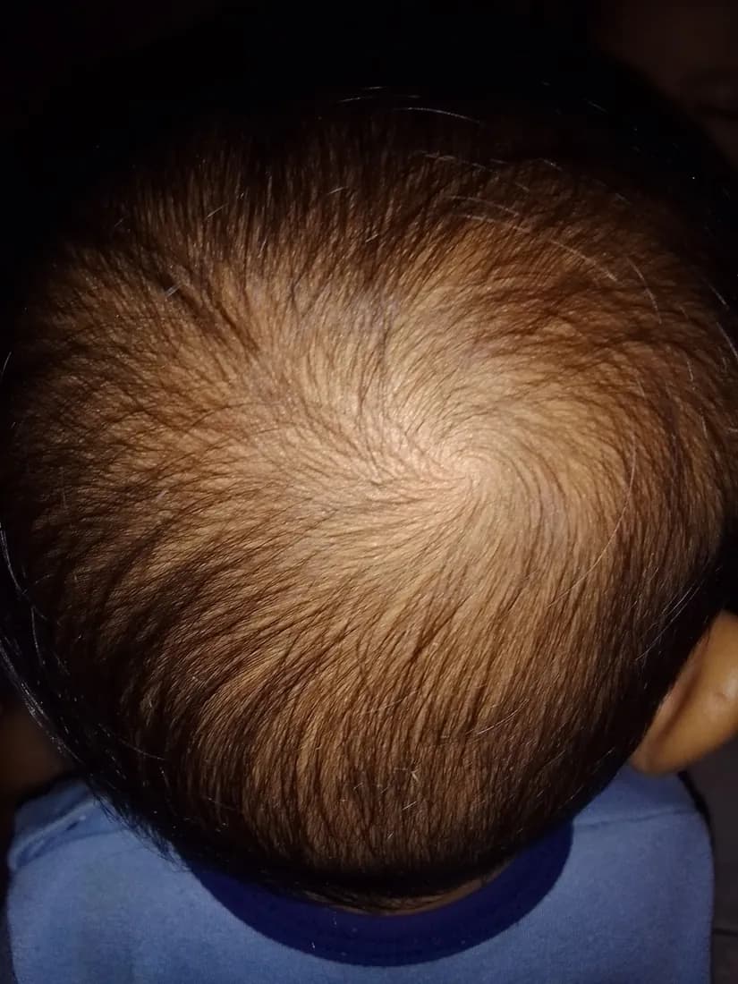 Rambut si Kecil, sebelum dan hari ke-14, Hari ke-14