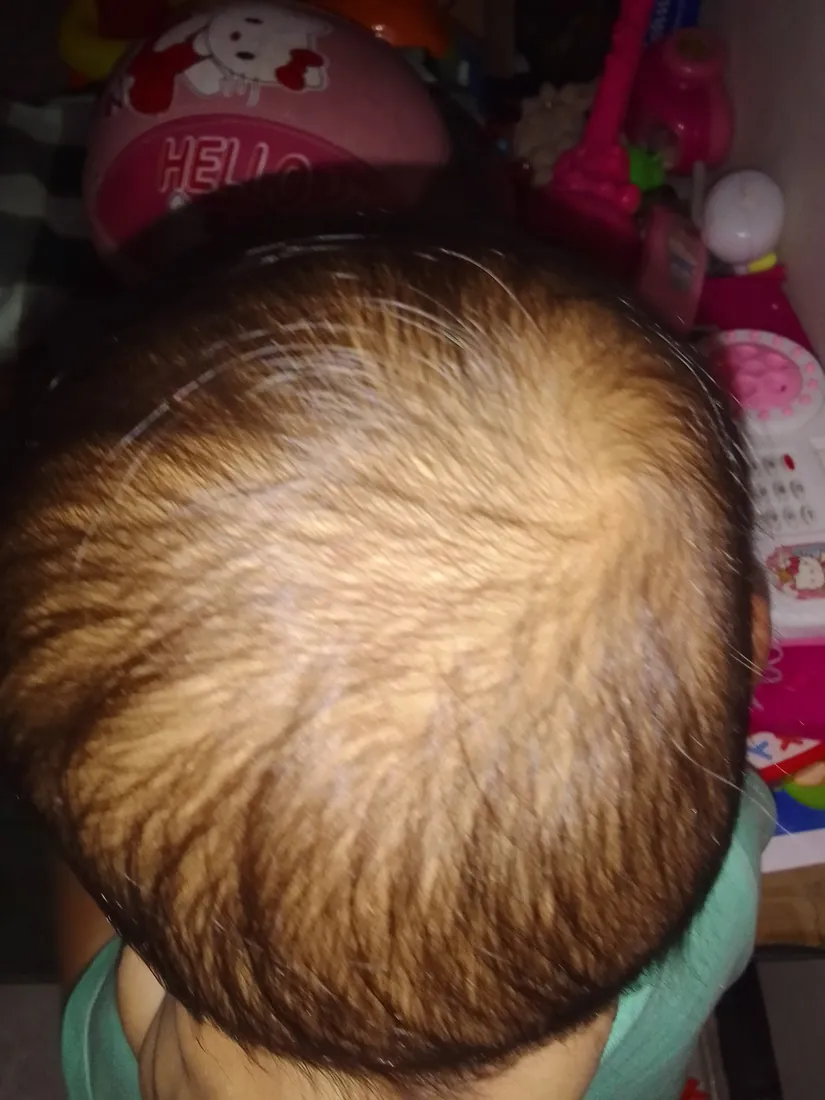 Rambut si Kecil, sebelum dan hari ke-14, Sebelum