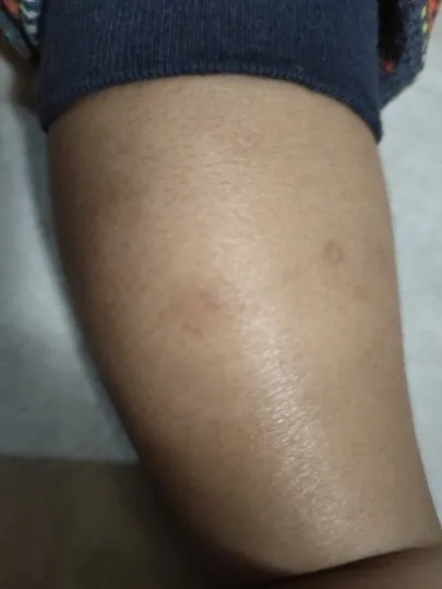 Bekas gigitan dan kulit kasar memudar, Sebelum
