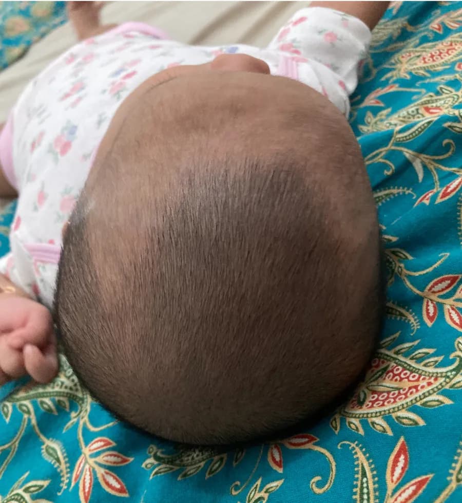 Rambut si Kecil, sebelum dan hari ke-14, Juli 2025