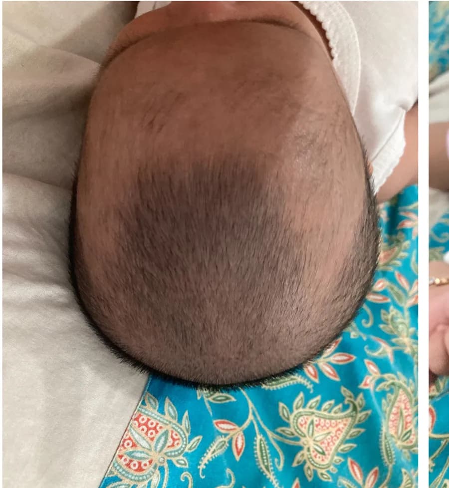 Rambut si Kecil, sebelum dan hari ke-14, April 2025