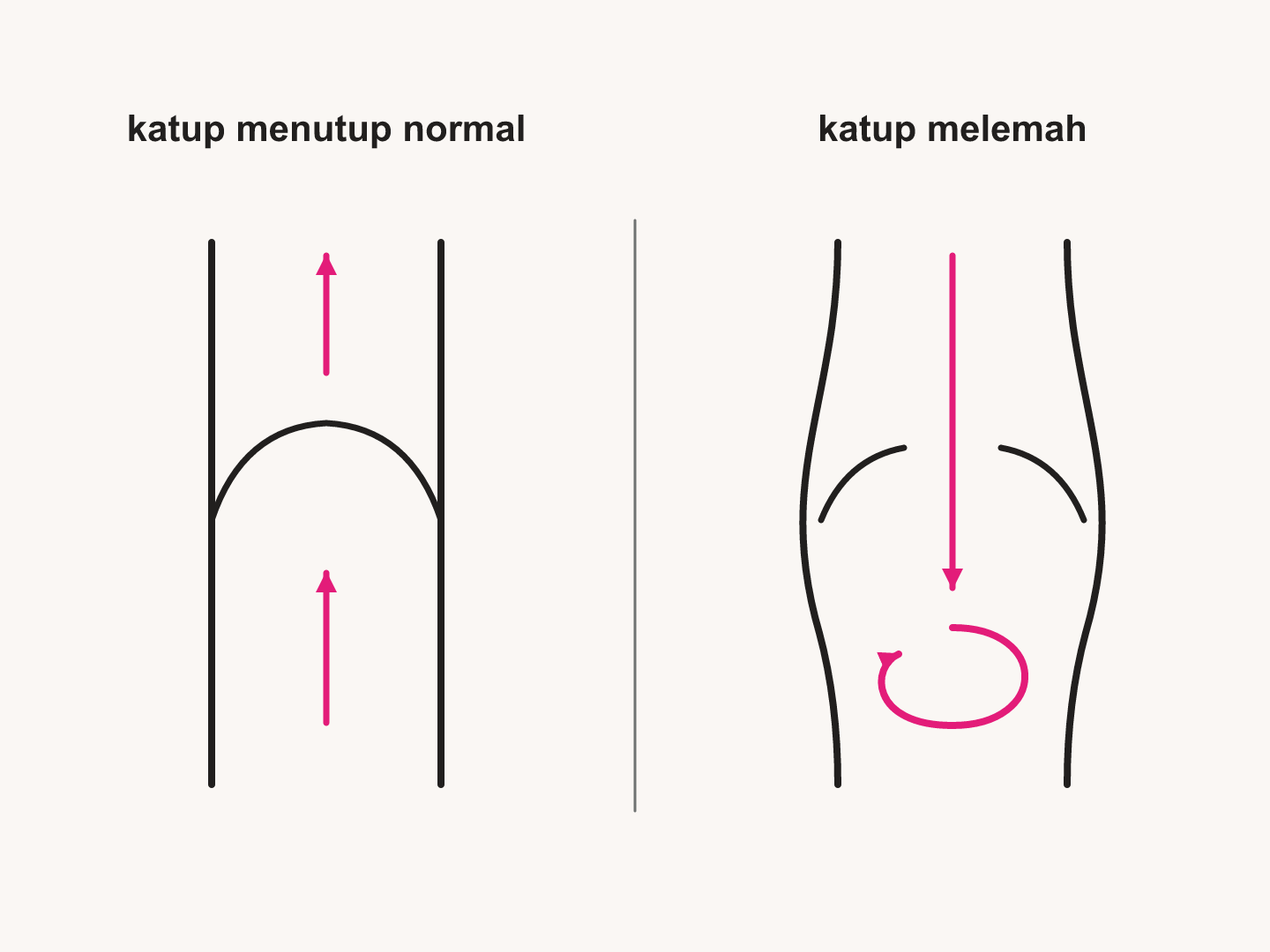 Katup normal mencegah aliran balik. Celah pada katup melemah memungkinkan aliran turun kembali dan penumpukan darah. Ini salah satu mekanisme varises, bukan seluruh penyebab.