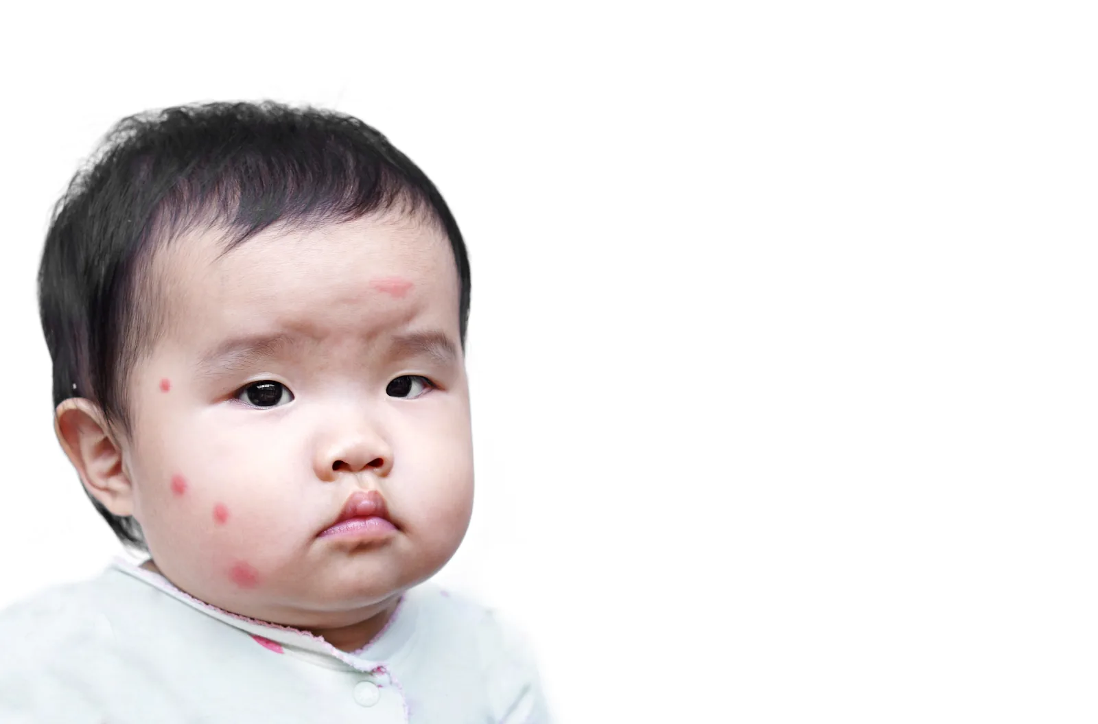 Bayi dengan bekas gigitan nyamuk di wajah