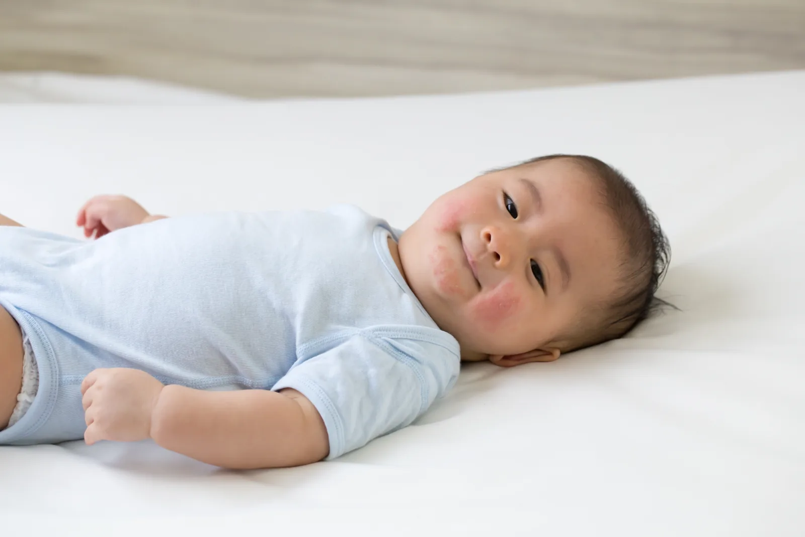 Bayi dengan ruam kulit sedang tersenyum