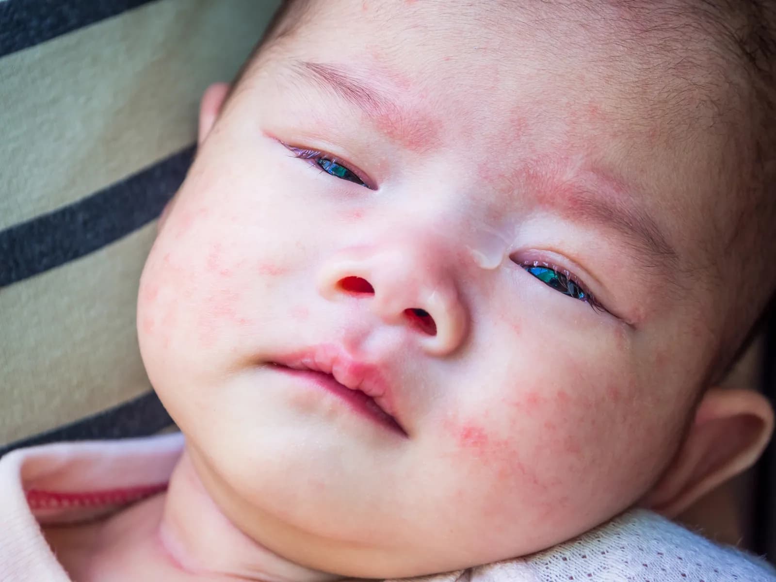 Bintik merah pada wajah bayi