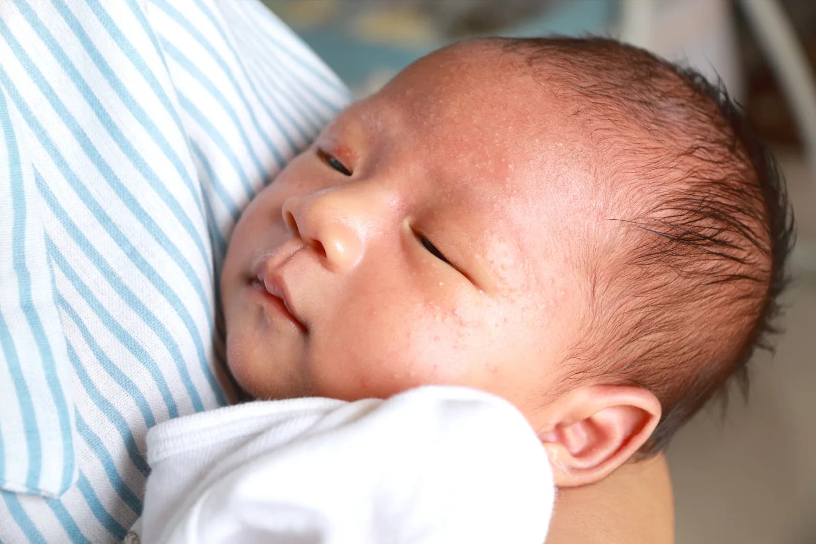 Ruam biang keringat pada wajah bayi