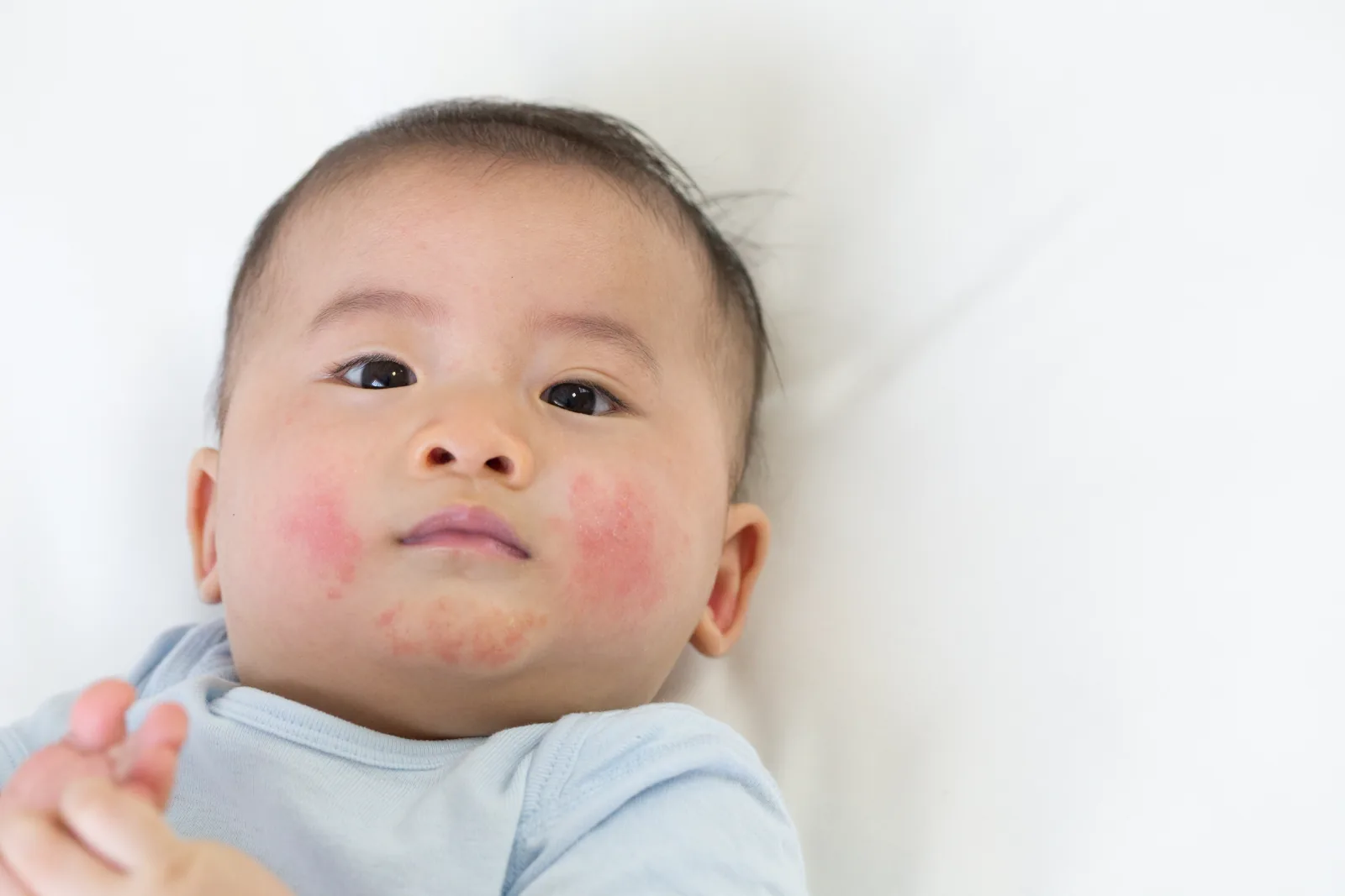 Ruam pada wajah bayi