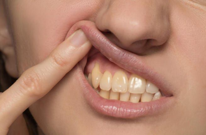 Fluorosis: gigi kuning akibat kelebihan fluoride