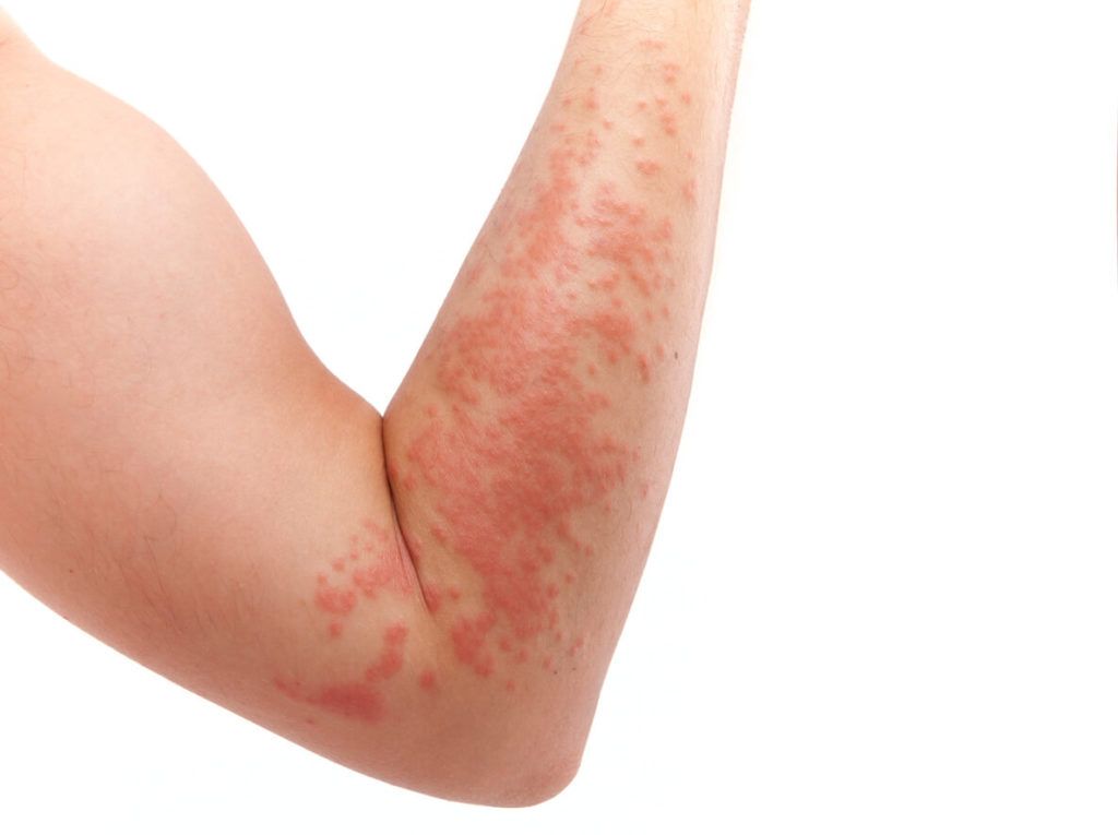 Paraben menyebabkan alergi, betulkah?